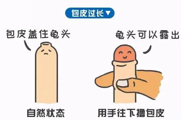 2.包茎:包皮过长且无法自行翻转露出g头,需要进行手术治疗.1.