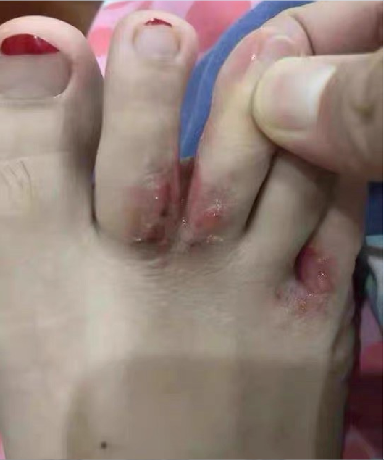 脚上痒痒水泡多多的克星了三个快速去除小技巧脚丫恢复光滑如初