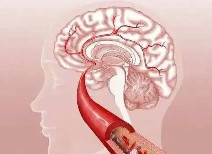 脑梗死为什么ct检查还要核磁共振