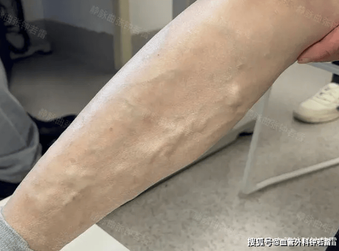 55岁还想再拼一把,做了静脉曲张微创手术,30天后摸着右腿笑出声_医生_