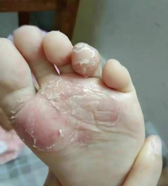 天天洗脚为什么还有脚气