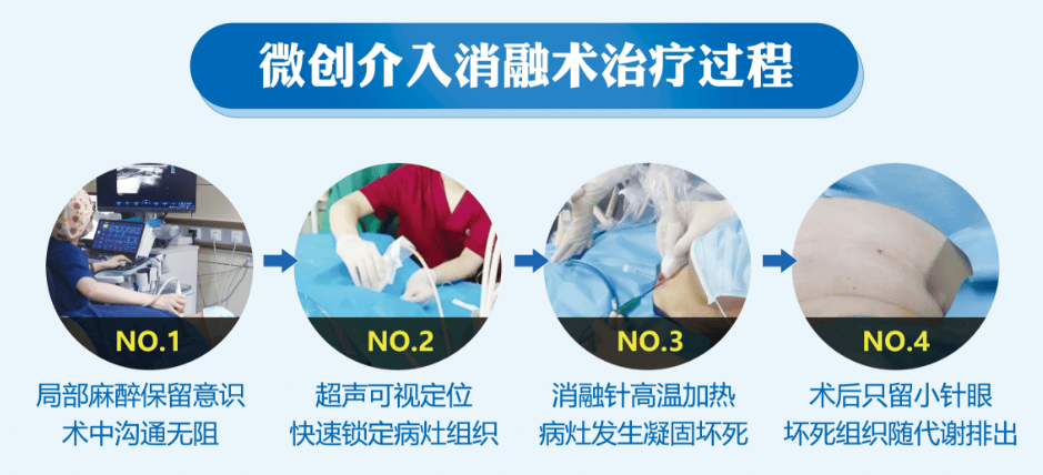 将细小1mm微波消融针精准直达病灶,介入治疗,通过发射高频微波热能量