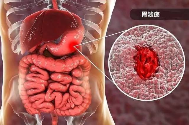 胃溃疡久拖不治,当心导致胃穿孔!
