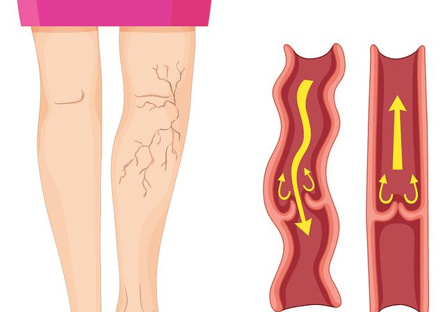 下肢静脉曲张卡通图片