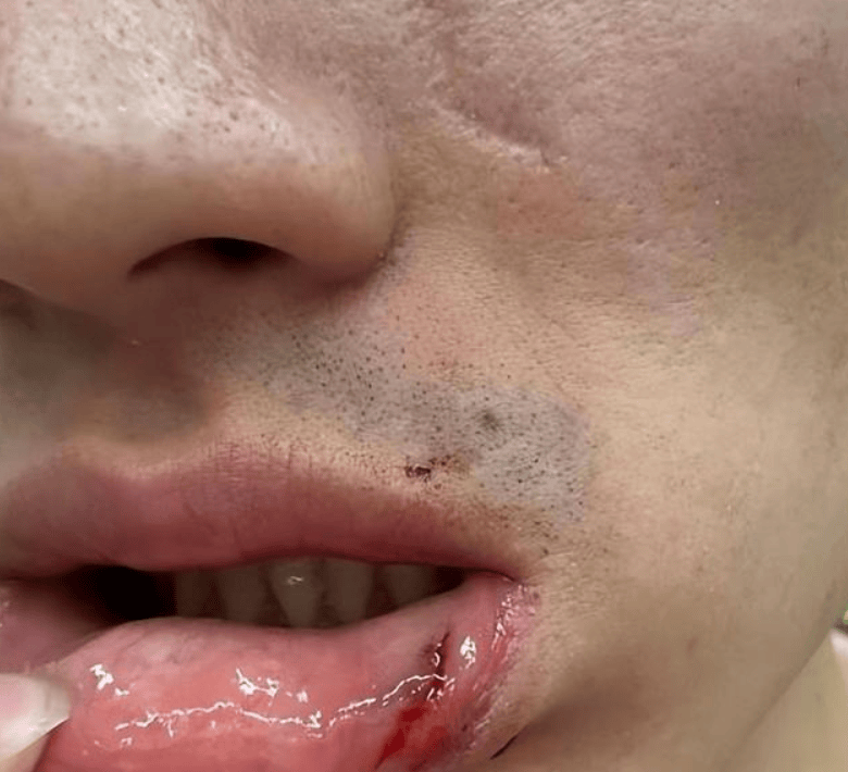 惨烈!齐麟晒于德豪嘴唇受伤的照片 黄荣奇核磁检查结果多处受伤