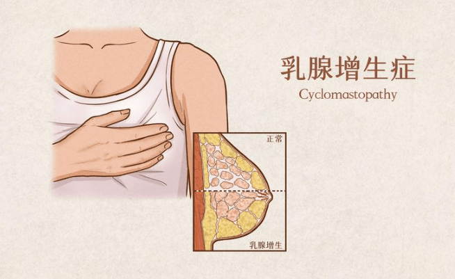 济南甲康医院王宗春主任乳腺讲解