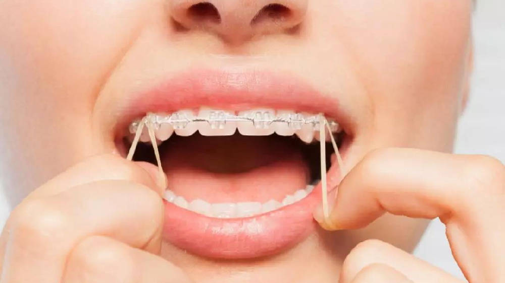 矫正牙齿的时候挂橡皮筋是为什么