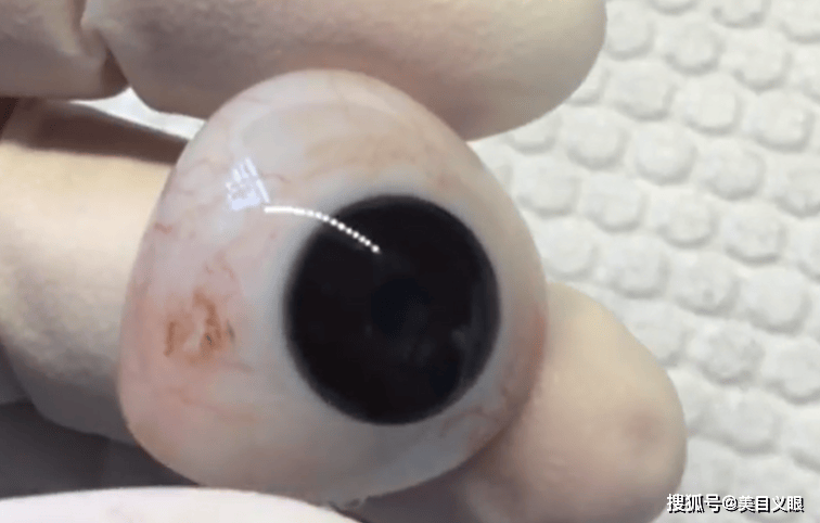 眼球摘除多年,30岁还有必要安装义眼台吗?