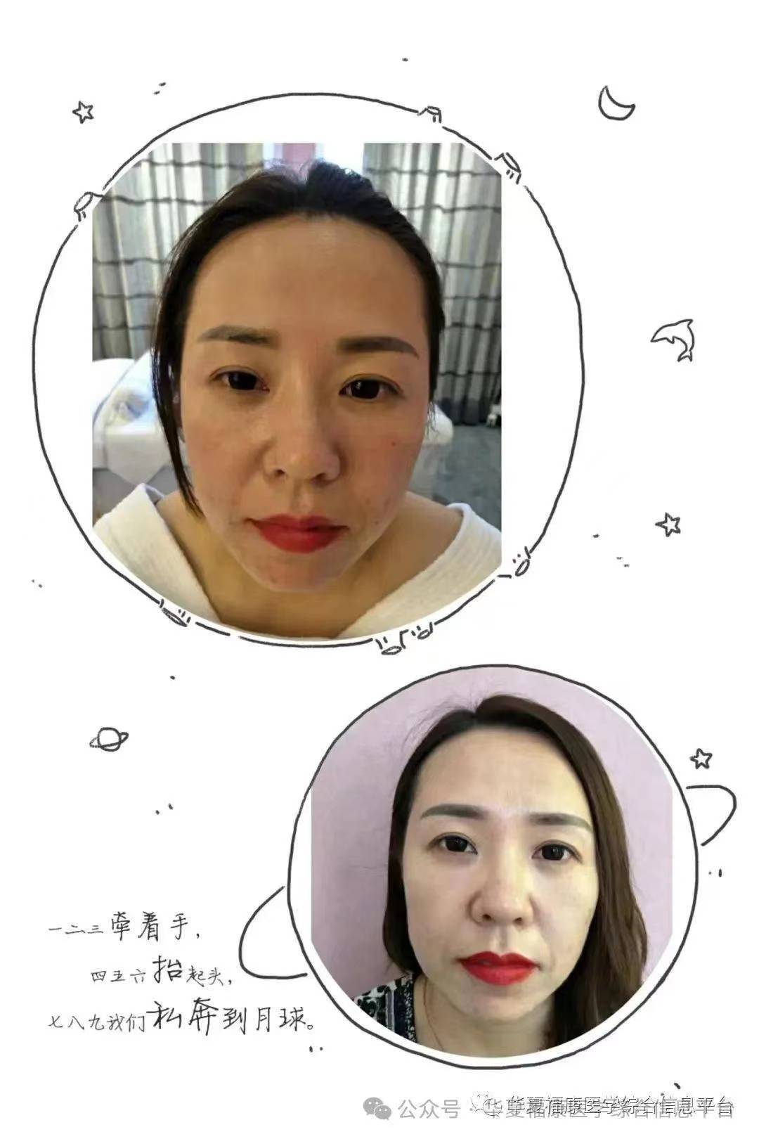 督脉通埋线疗法与中式埋线减肥塑形培训班2024年7月19日.昆明