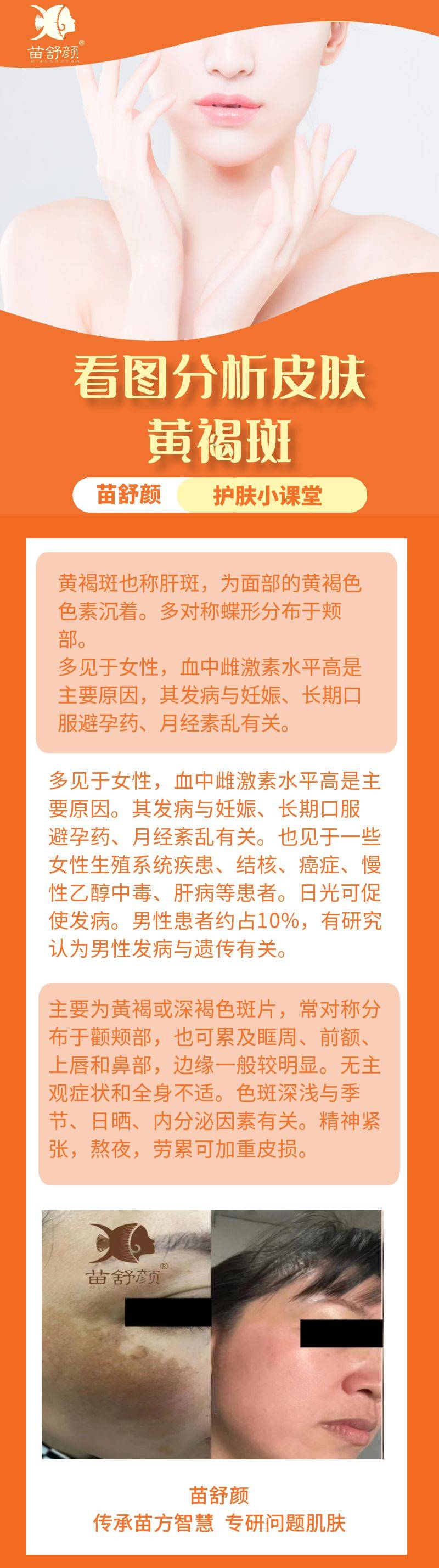 苗舒颜护肤小课堂·看图分析皮肤·黄褐斑