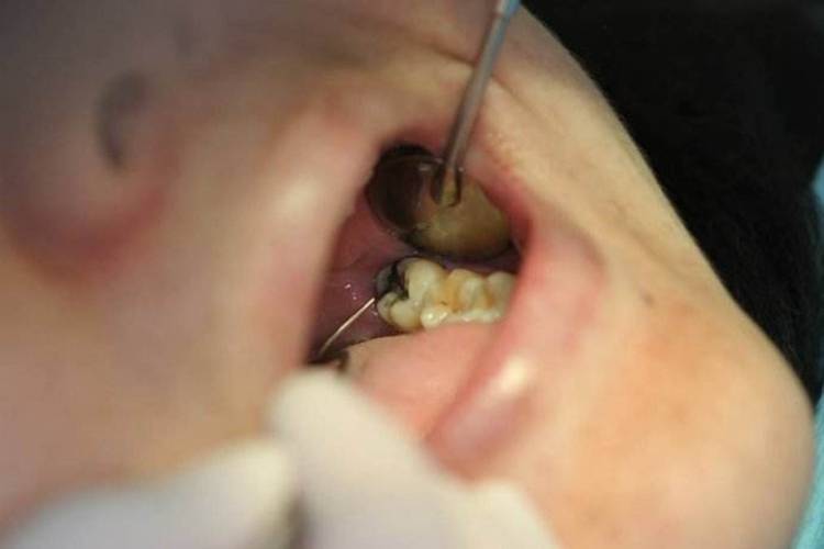 顺义口腔专家讲解:智齿到底要不要拔?