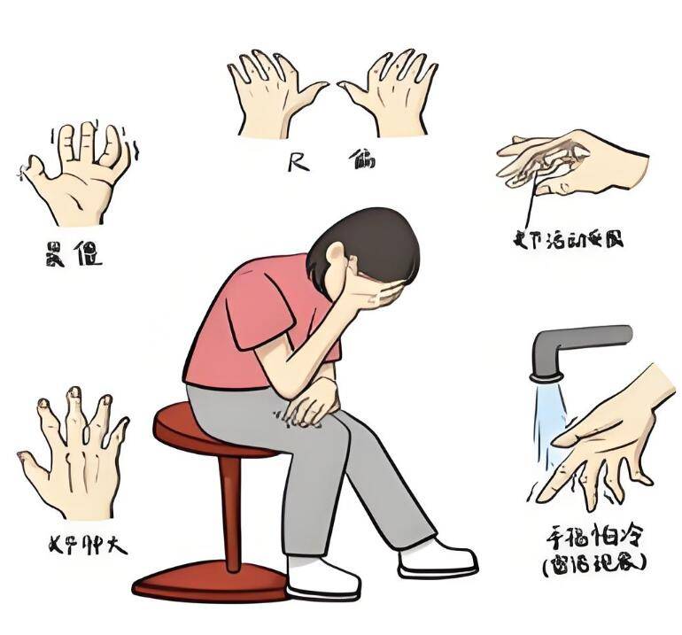 警惕!类风湿性关节炎不一定导致变形,关键在预防策略