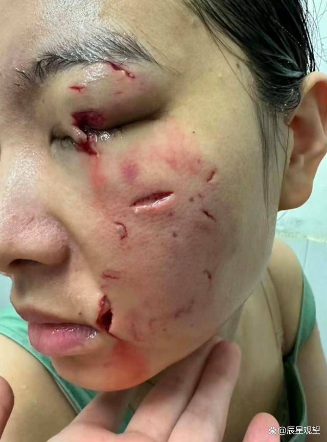 江苏女子路边被狗咬,女子前往上海治疗,脸部伤痕累累