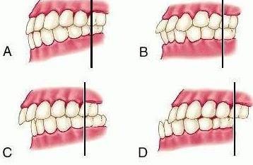 邢台正畸专家王振莉:牙齿整齐不代表咬合正常