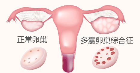 多囊卵巢综合症的临床表现(卵泡多是多囊卵巢综合征吗)