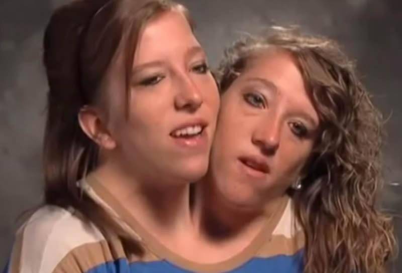 美国连体姐妹:共用一个身体,拿到驾照当上老师,31岁渴望结婚