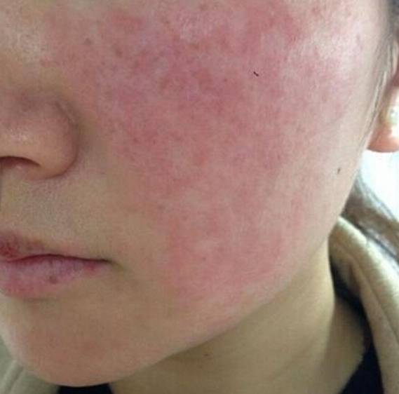 脸上皮肤痒还长水疱!怎么办!长沙皮肤病医院专家来帮您!