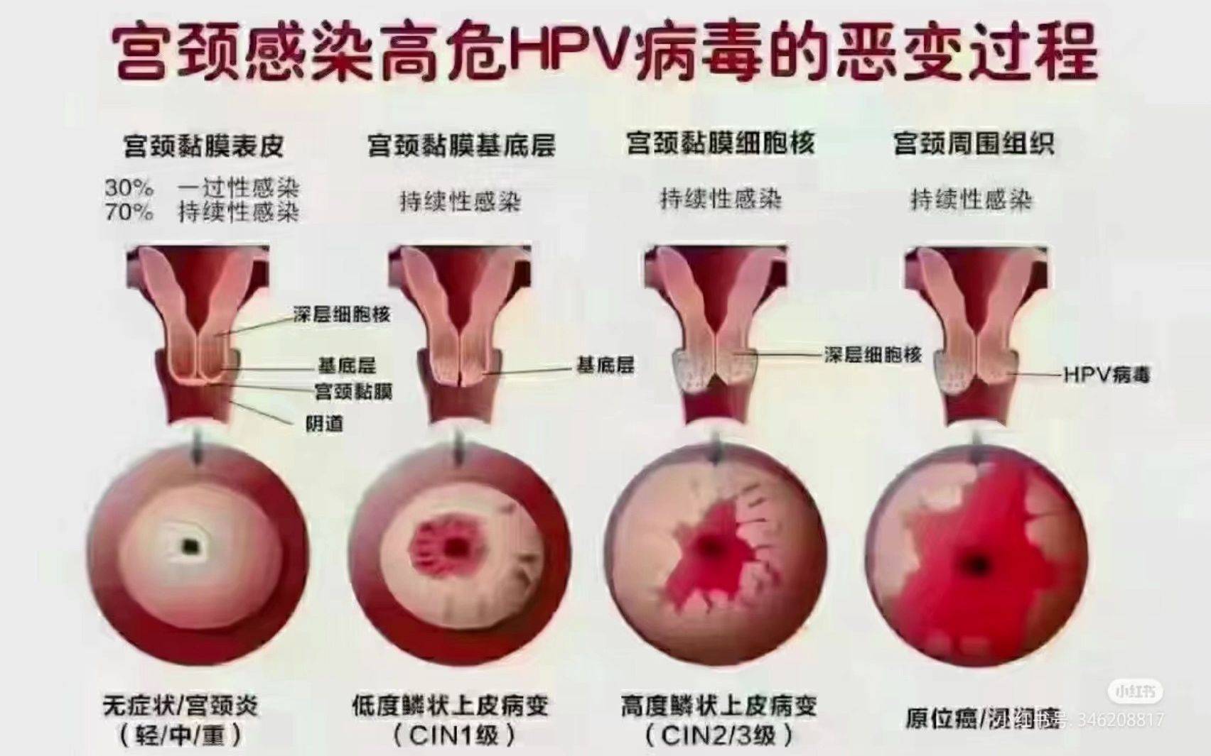 宫颈癌图片晚期图片