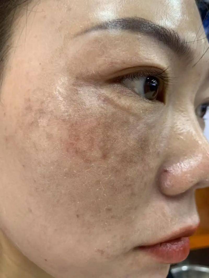 宿迁楚街皮肤病医院:带你了解黄褐斑