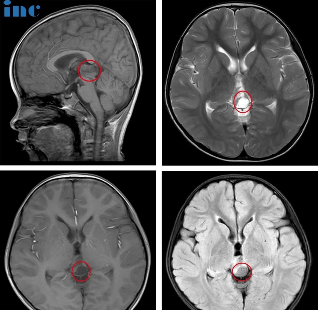 儿童松果体区占位性病变有什么症状表现?能手术吗?