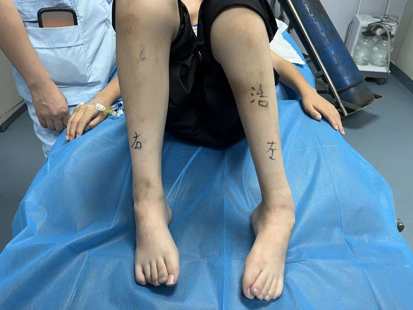 马蹄内翻足男孩的"奔跑梦":胡霞中医无创非手术技术改写畸形命运