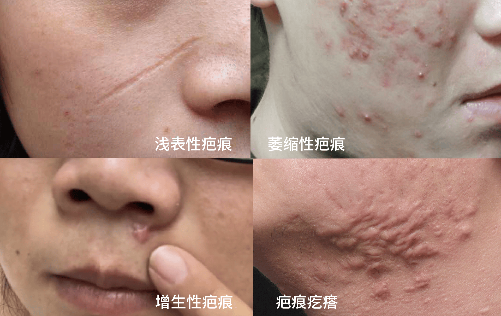 面部疤痕怎么治?恢复漂亮脸蛋,这里有详细的解决方案!