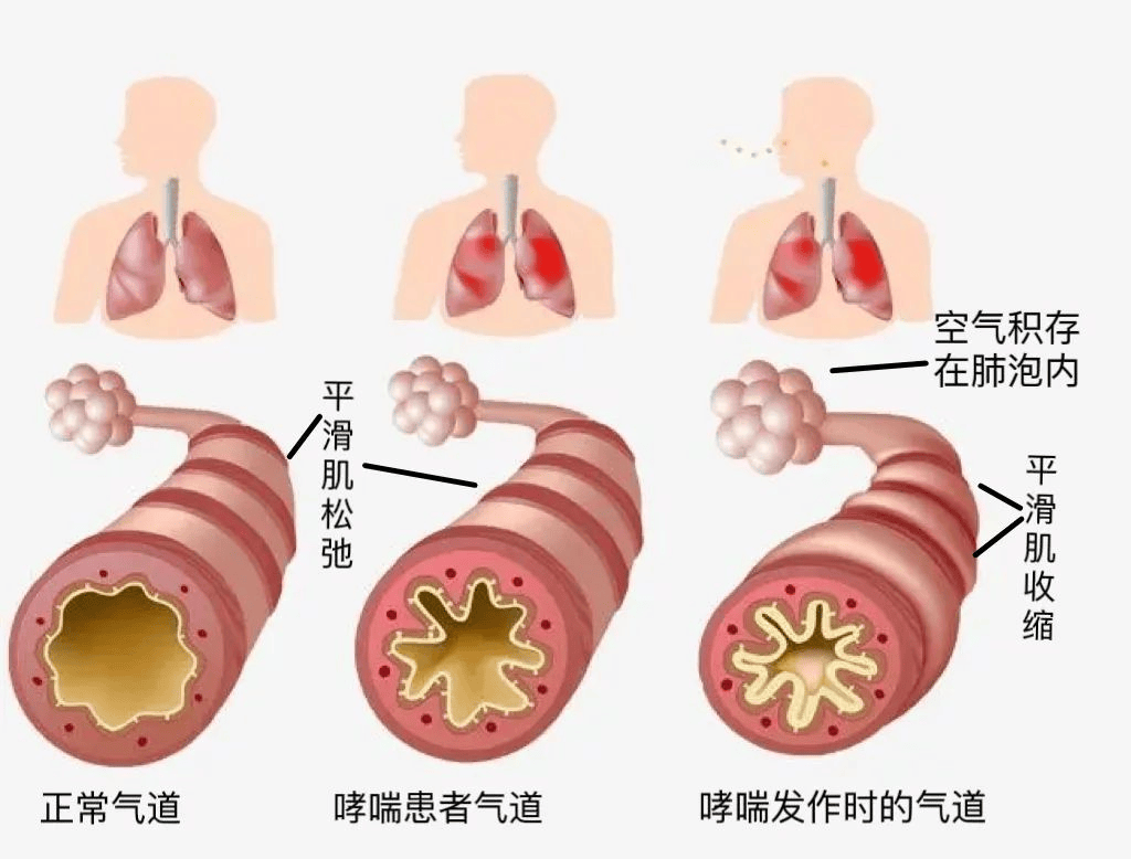 李邦良医生:科学治疗支气管哮喘的核心策略与前沿方案