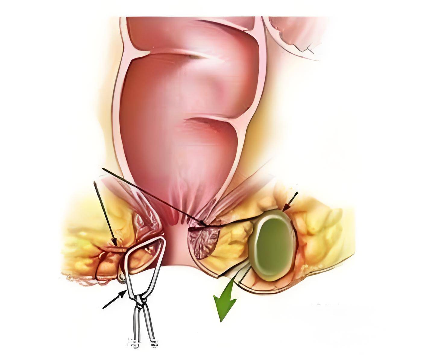 潍坊鸢飞肛肠外科医院解决:肛周脓肿的隐痛,你忽视的健康警报,别让它