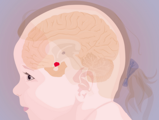 文献学习||儿童期发病的颅咽管瘤相关下丘脑综合征的治疗策略