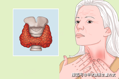 甲状腺疾病越来越年轻化！年轻人的4个“隐形伤腺”习惯，很多人天天在犯