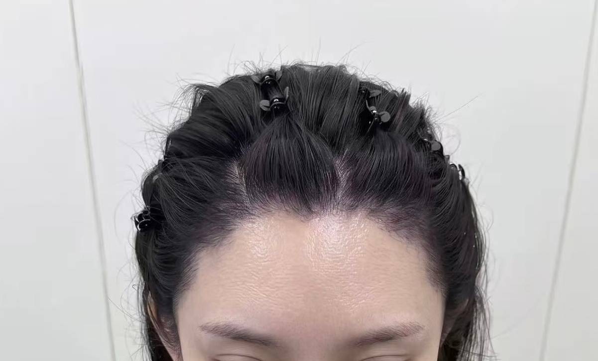 深圳植发要趁早，但先看清你适不适合？