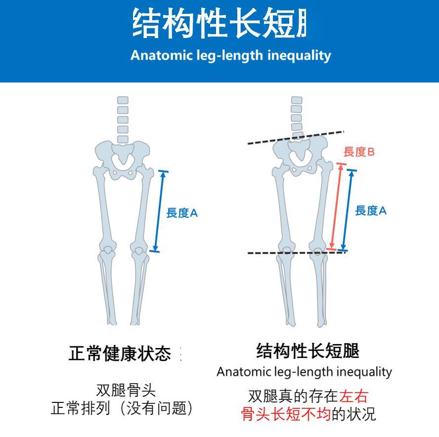 长短腿差多少cm