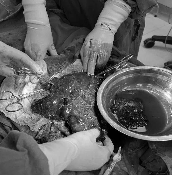 典型病例丨龙海一女子停经后出现阴道出血,竟不知已胎死腹中~警惕胎盘