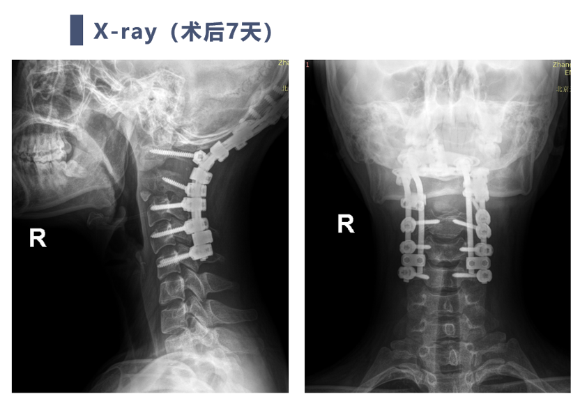 宣武有術|後路聯合極外側入路顱頸交界脊索瘤切除 頸椎四棒系統固定