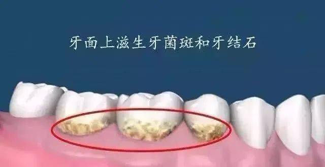 牙龈出血频繁,罪魁祸首是什么_口腔_牙齿_问题