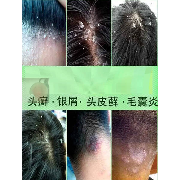 女生用去屑洗发水推荐_头皮_问题_原因