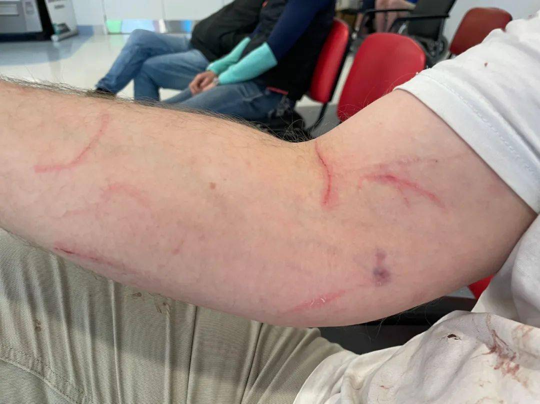 新西兰华人爆料：老公出门遭恶犬无故撕咬，鲜血淋漓！至今找不到狗和主人......