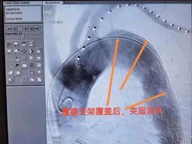 肱動脈—穿刺右股動脈—精確定位釋放腹膜支架—腹腔臟器血管真腔開通