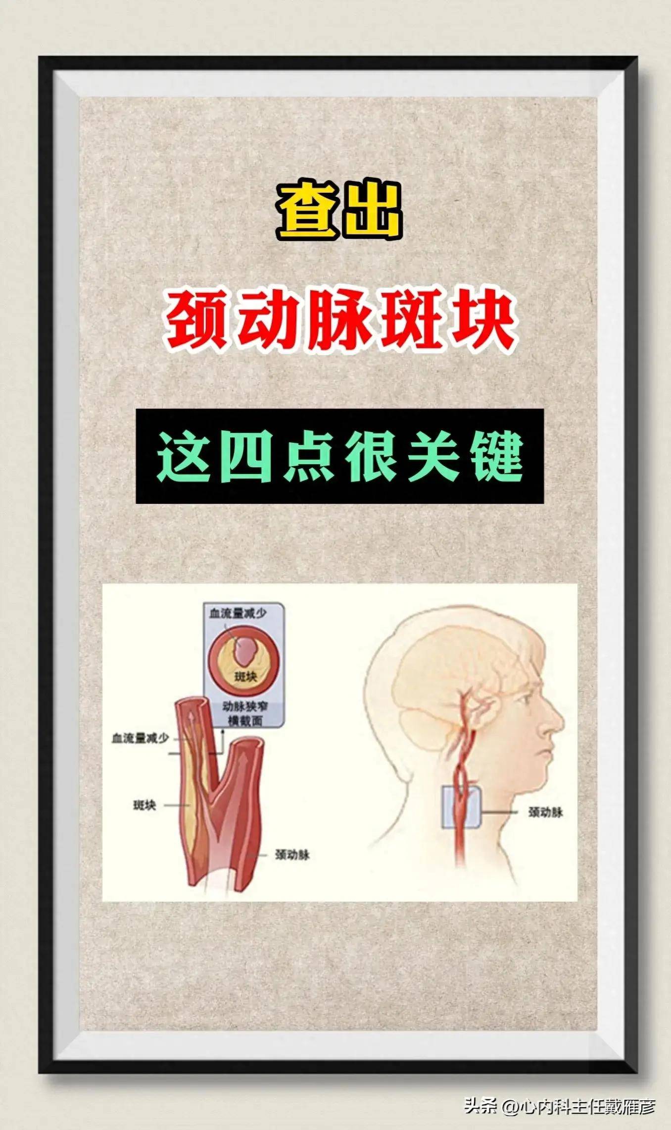 颈动脉斑块的位置图片图片