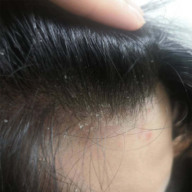 头皮痒有大块头屑用什么洗发水好?