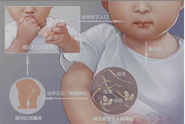 小孩肛周瘙痒,家长需警惕蛲虫感染_儿童_虫卵_肛门