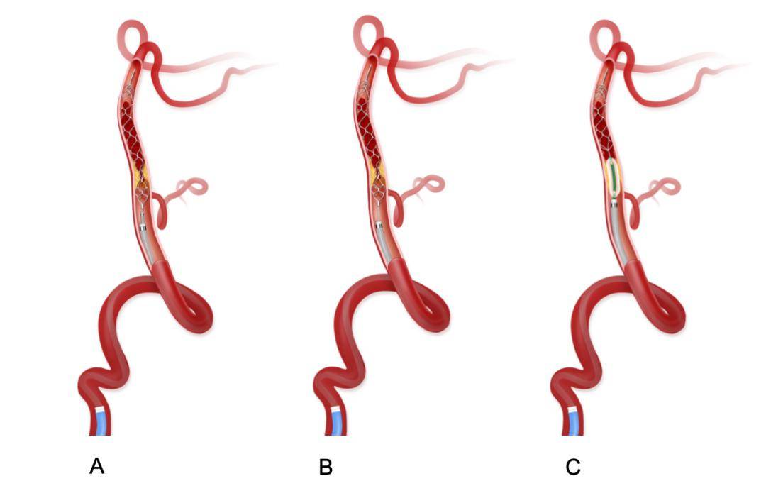 微导管内套取栓支架送至中间导管前端后释放h.