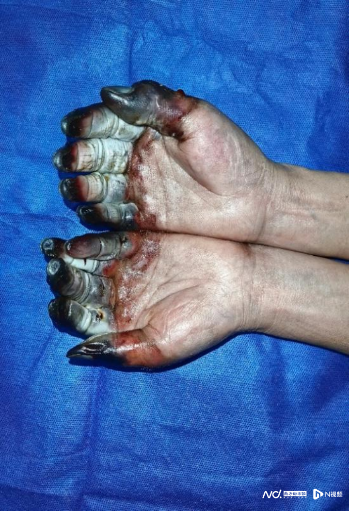 有人冻伤致截肢,患者增加!医生紧急提醒_皮肤_进行_天气