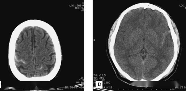 值班必備 | 急診顱腦ct常見的八種疾病_效應_高密度