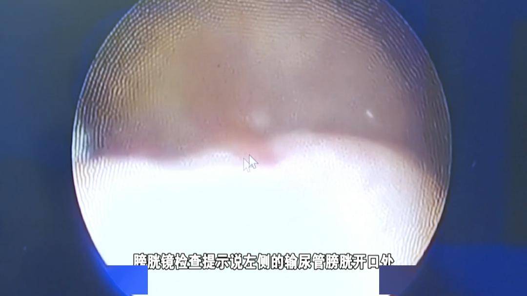 然后当时就给他联系了外科做了一个膀胱镜,膀胱镜检查提示说,左侧的输