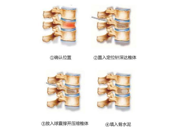 pkp手术进针点图解图片