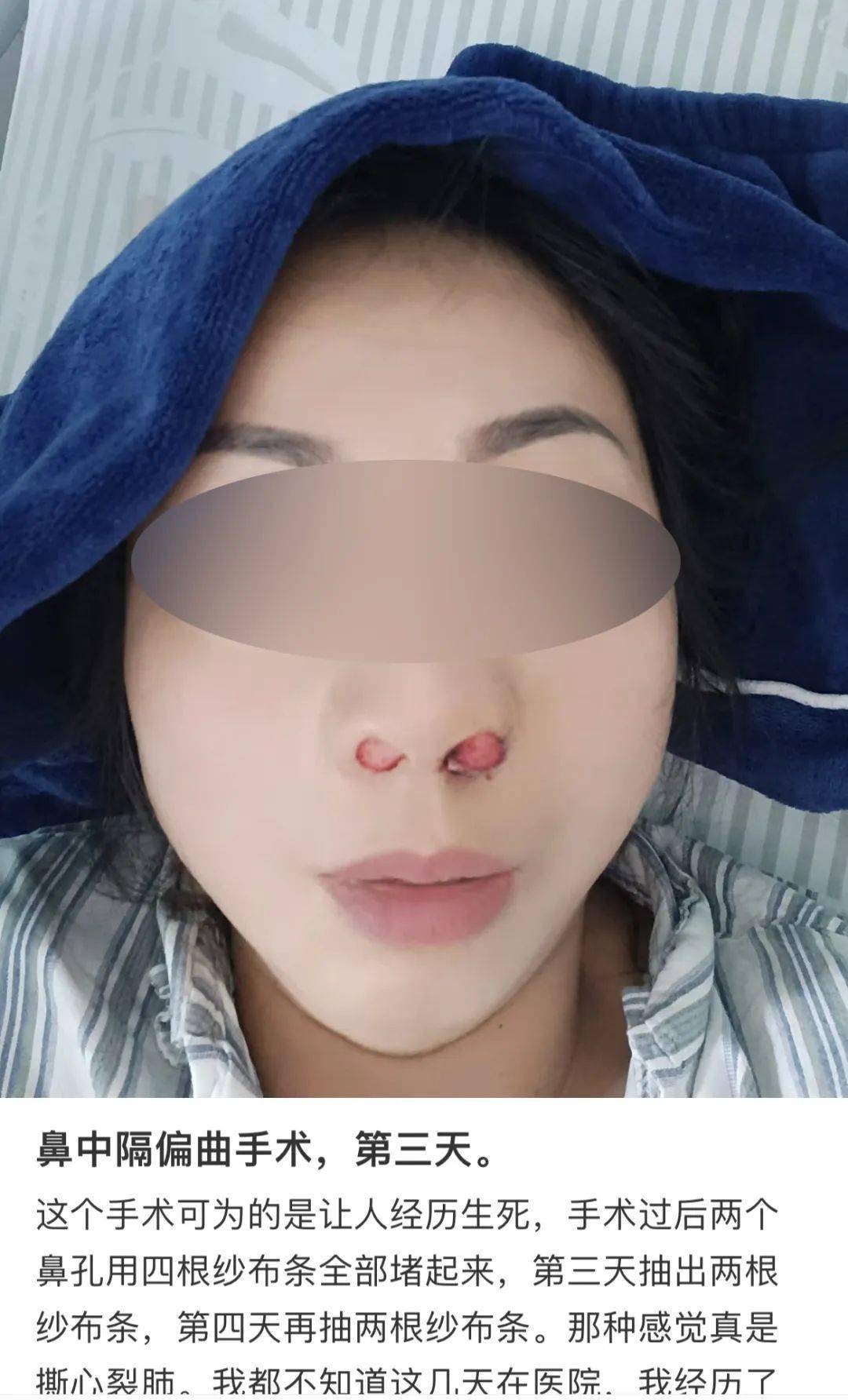 鼻中隔手术后塌陷图图片