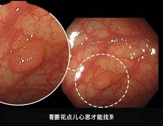 肠镜下的肠癌图片图片