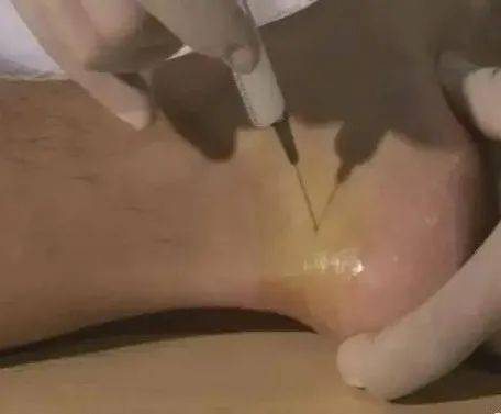 腱鞘炎√韧带炎√医生:当然不是.