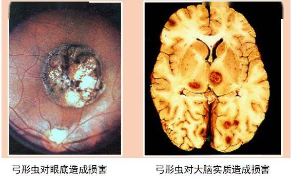 大脑寄生虫初期症状图片